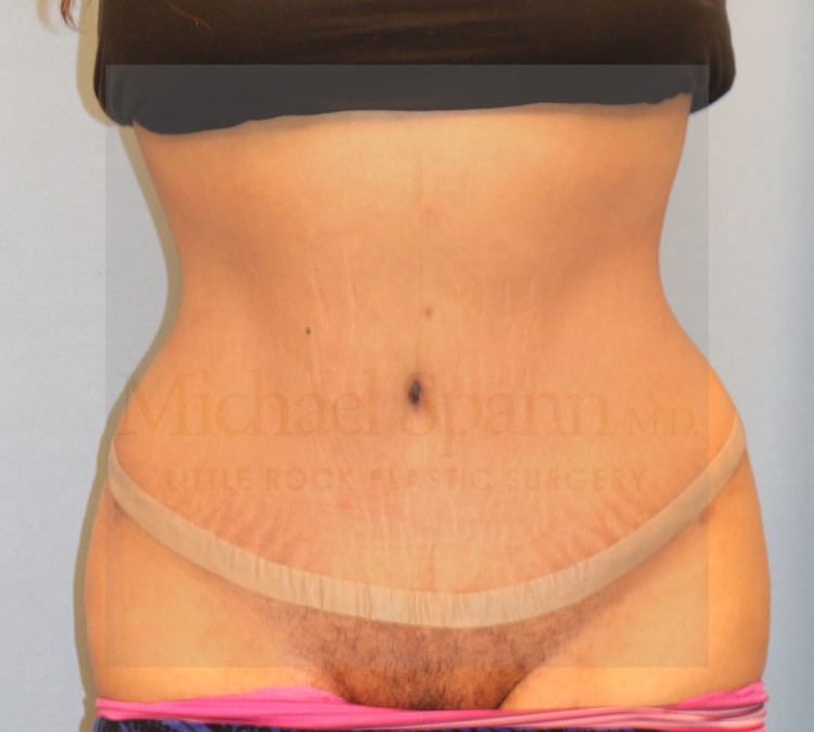After Image: Tummy Tuck - front