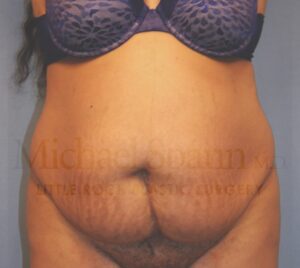 Before Image: Tummy Tuck