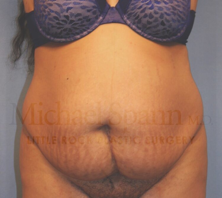 Before Image: Tummy Tuck - front