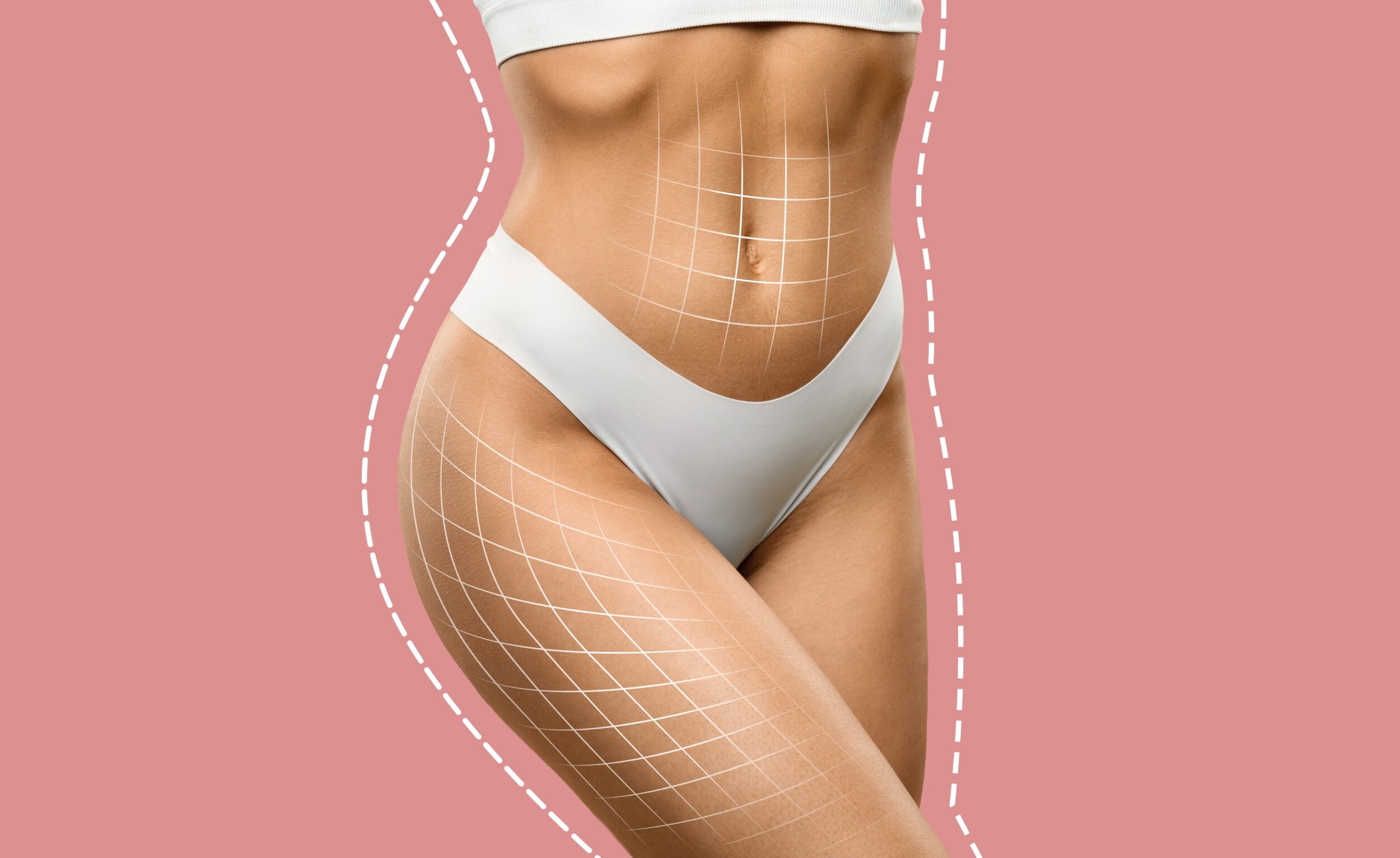Cropped image of a fit woman in white underwear with contouring lines, symbolizing body shaping, anti-cellulite treatment, or liposuction results
