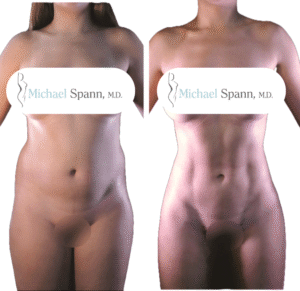 I definition liposuction for and after
