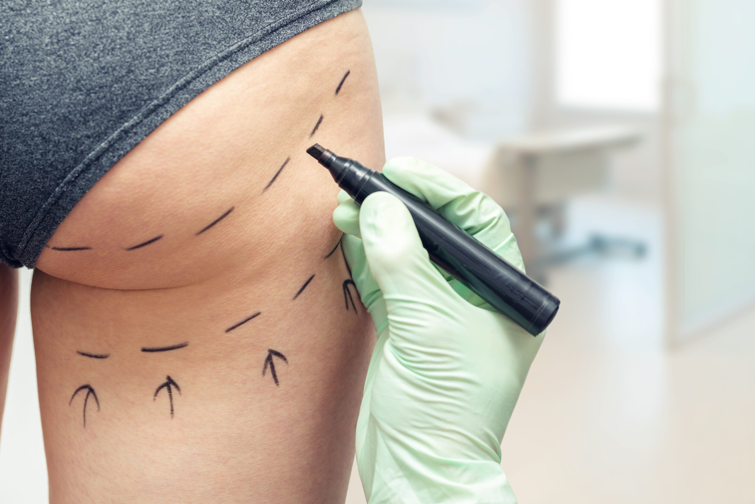 Plastic surgeon marking a woman’s body in preparation for a Brazilian butt lift, outlining areas for liposuction and fat transfer to enhance gluteal shape and contour