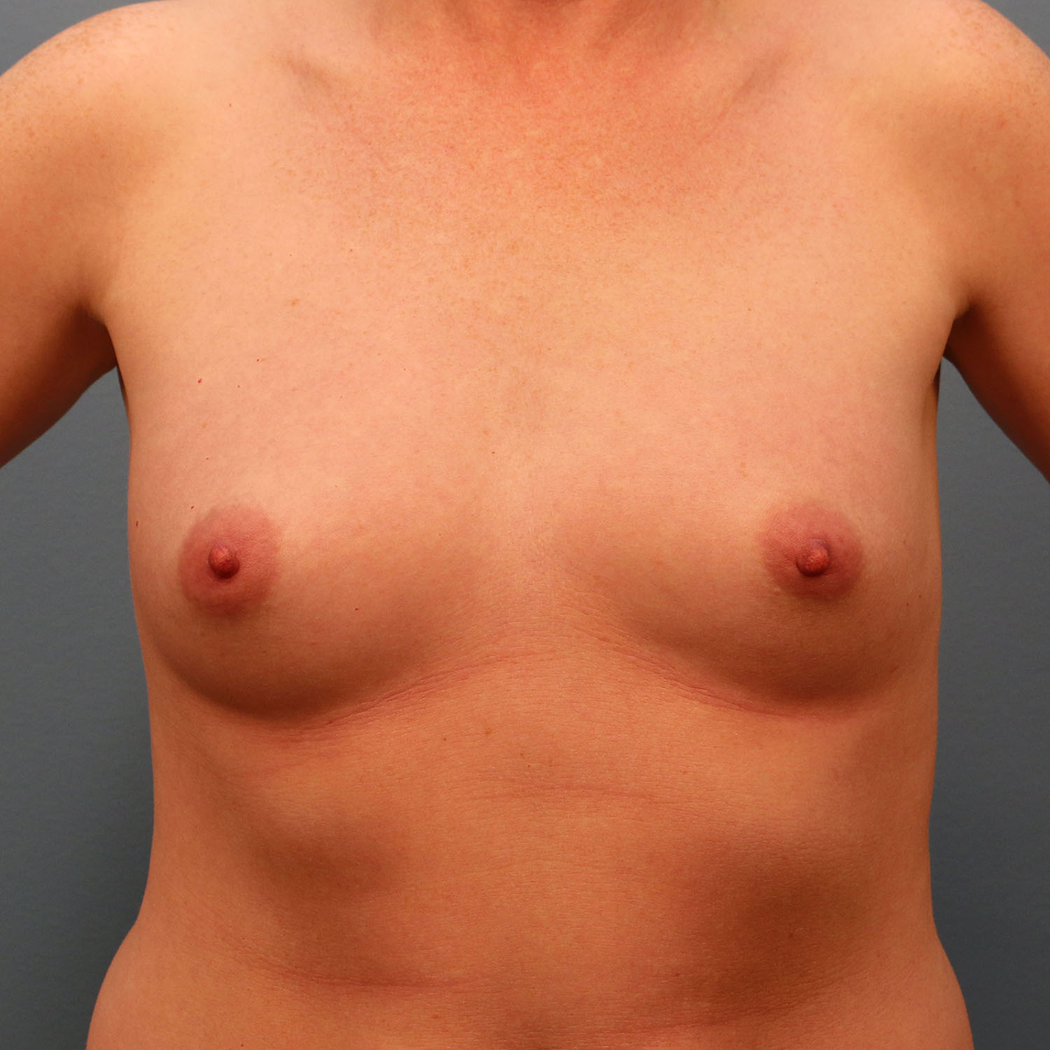 Before Image: Breast Augmentation with Mastopexy - front