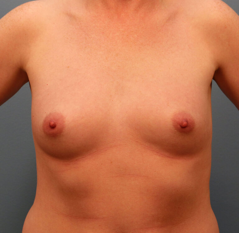 Before Image: Breast Augmentation with Mastopexy - front