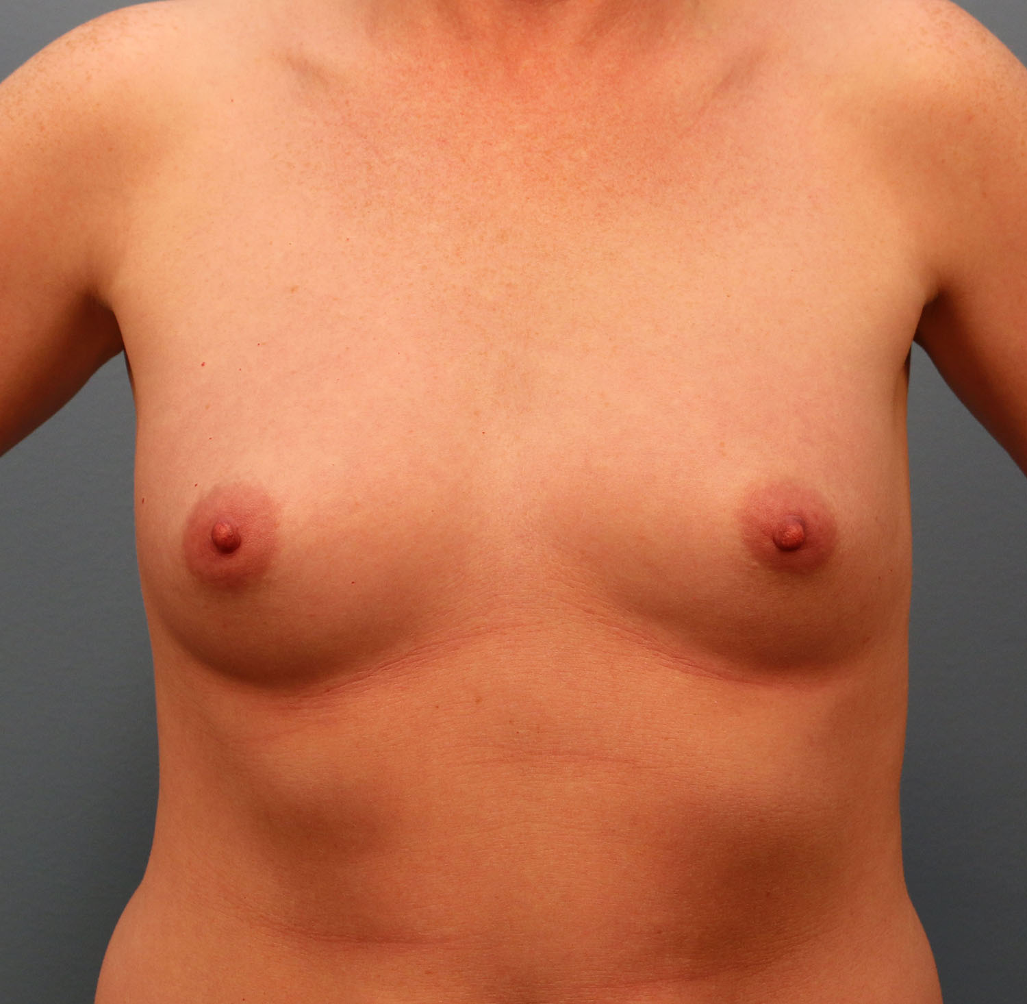 Before Image: Breast Augmentation with Mastopexy - front