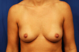 Before Image: Breast Augmentation with Mastopexy