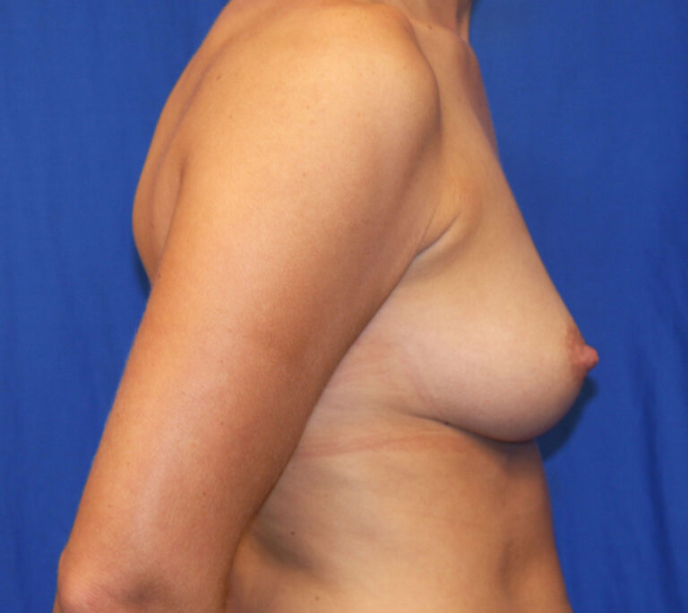 Before Image: Breast Augmentation with Mastopexy - right-side