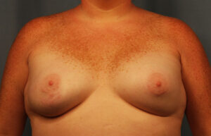 After Image: Breast Augmentation with Mastopexy