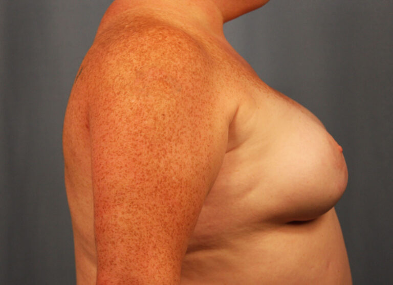 After Image: Breast Augmentation with Mastopexy - right-side