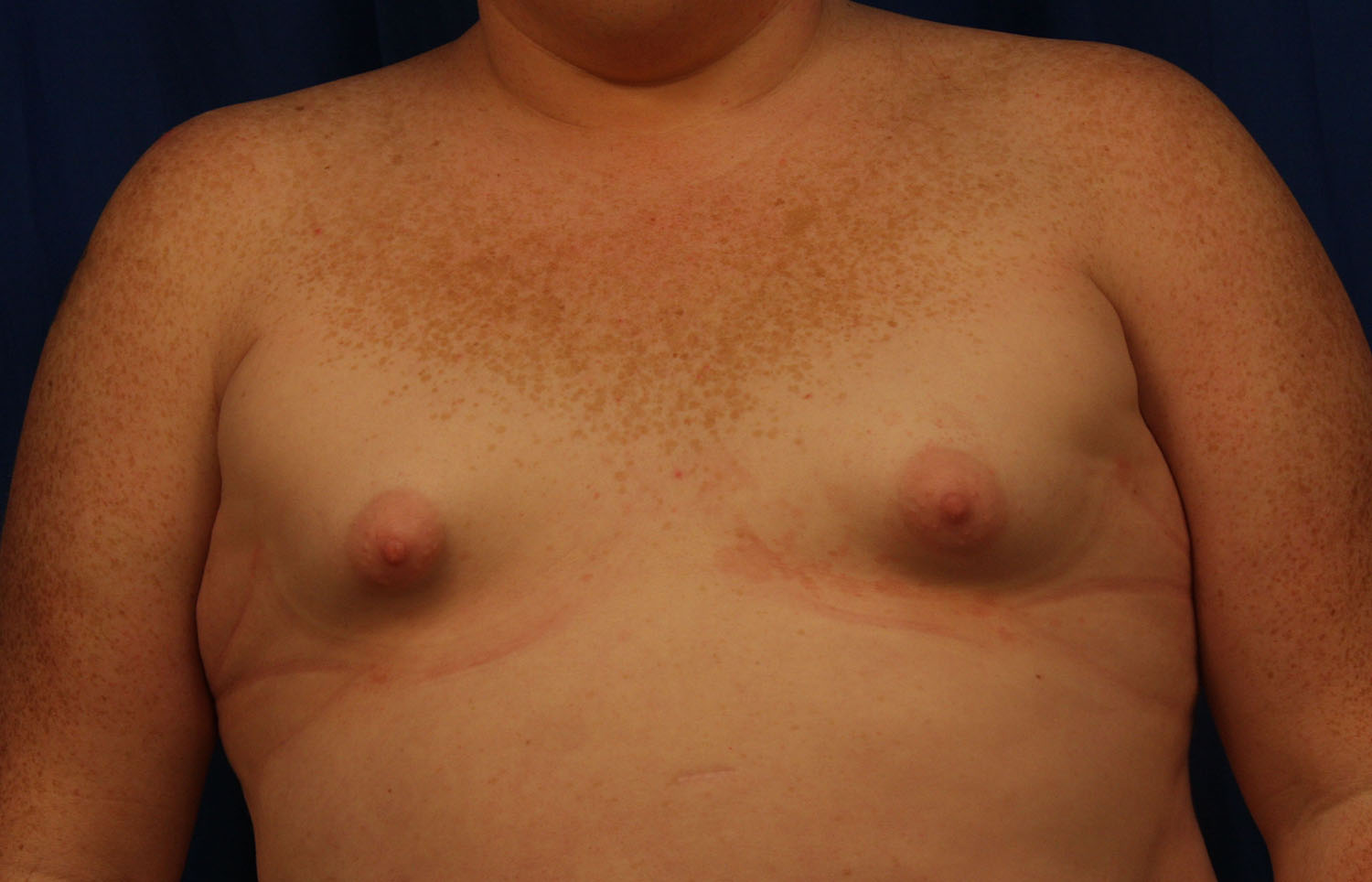 Before Image: Breast Augmentation with Mastopexy - front