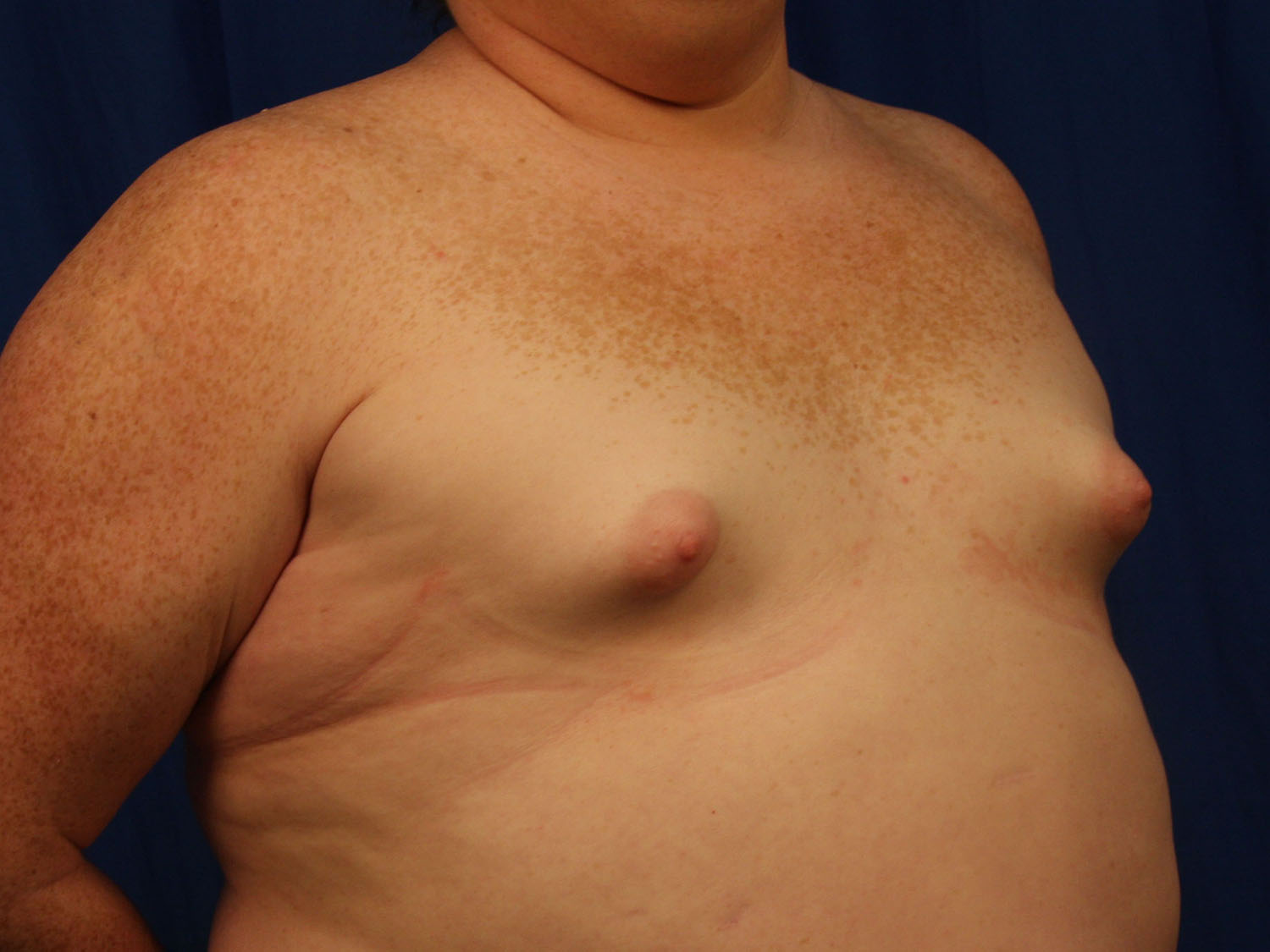 Before Image: Breast Augmentation with Mastopexy - right-front-oblique