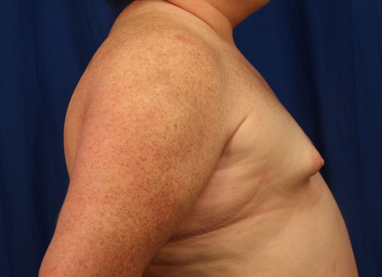 Before Image: Breast Augmentation with Mastopexy - right-side