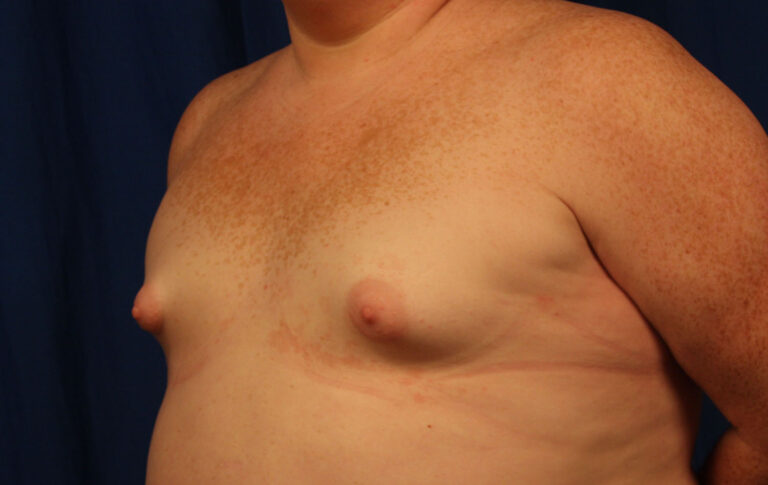 Before Image: Breast Augmentation with Mastopexy - left-front-oblique