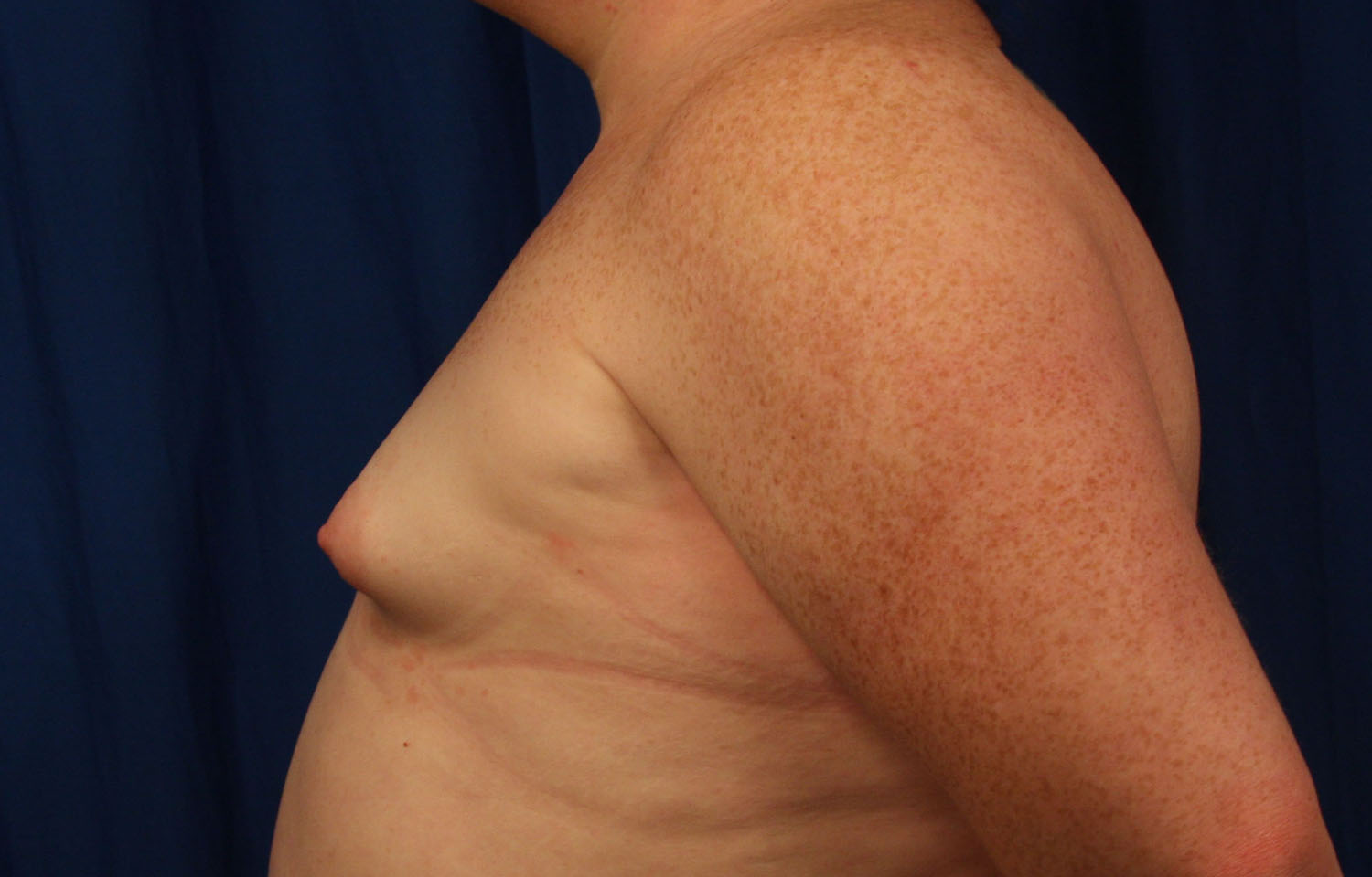 Before Image: Breast Augmentation with Mastopexy - left-side