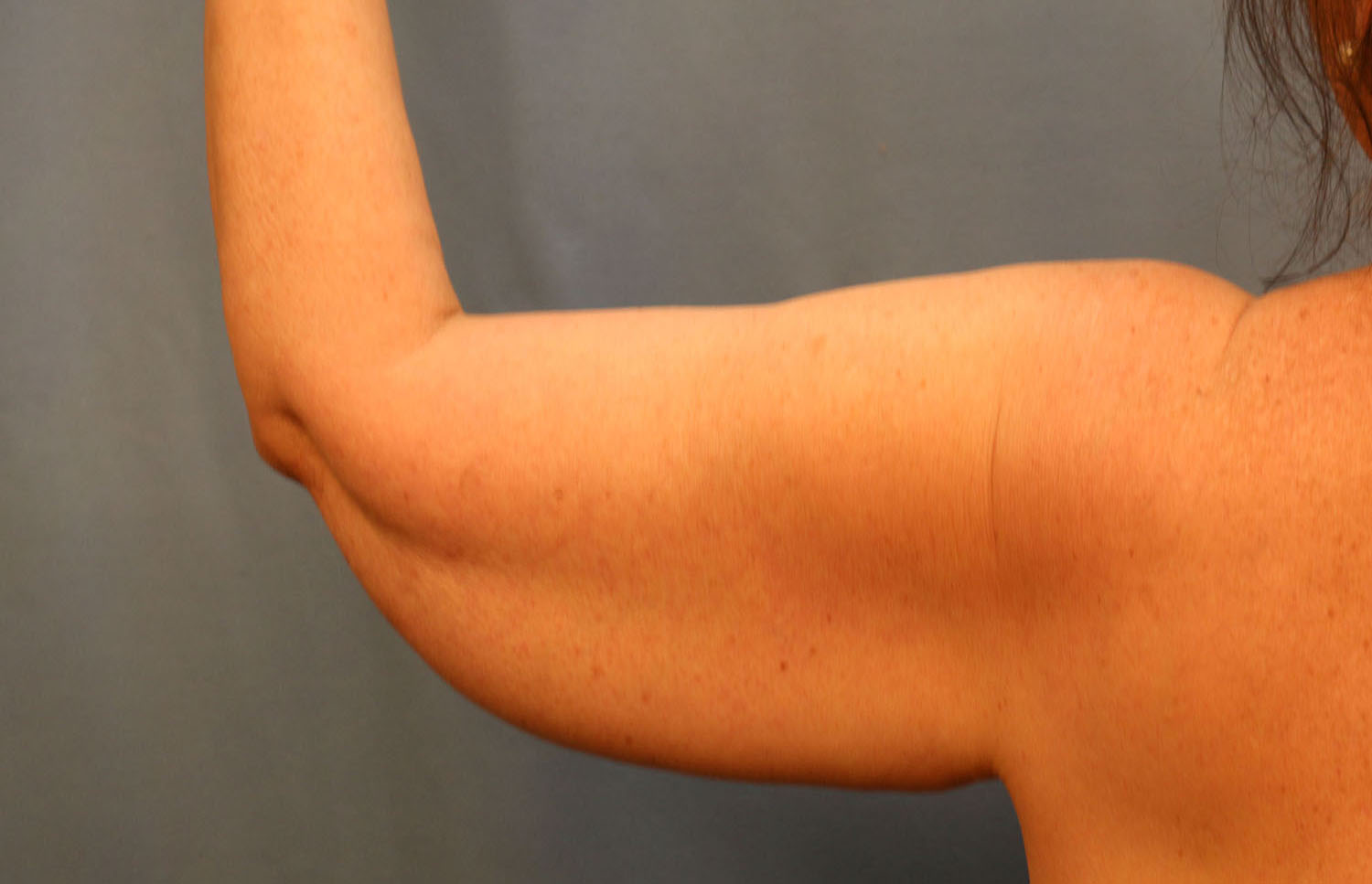Before Image: Brachioplasty - back