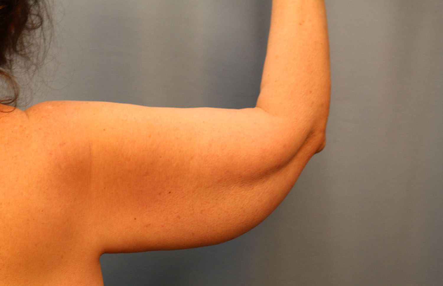 Before Image: Brachioplasty - back