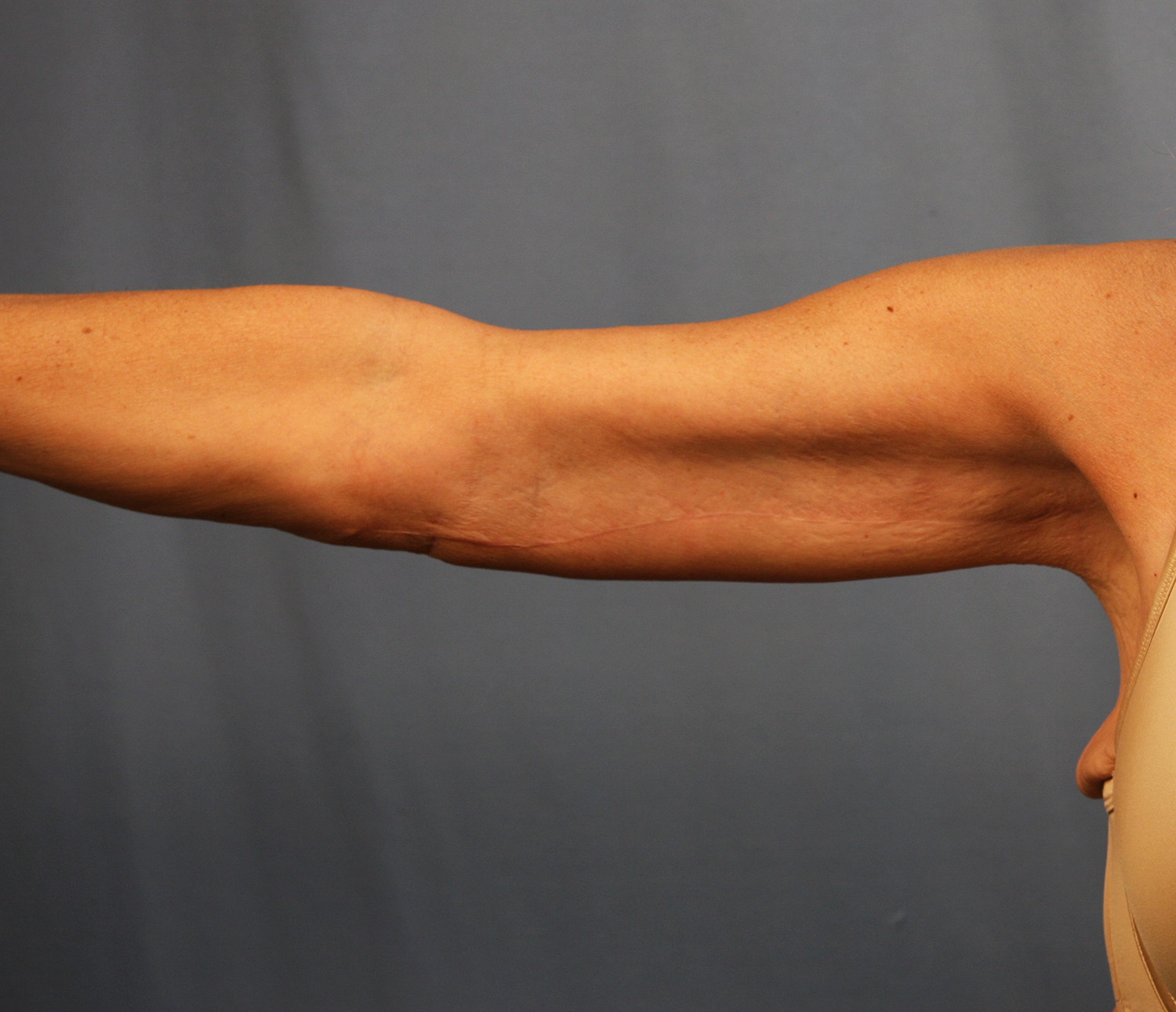 After Image: Brachioplasty - front