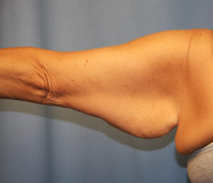 Before Image: Brachioplasty