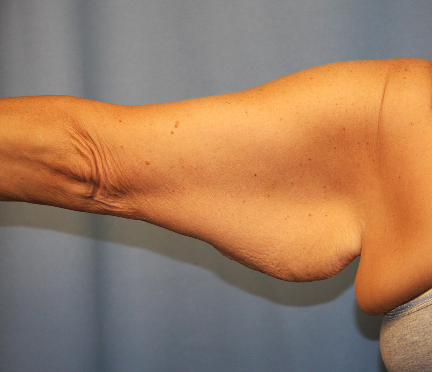 Before Image: Brachioplasty - front