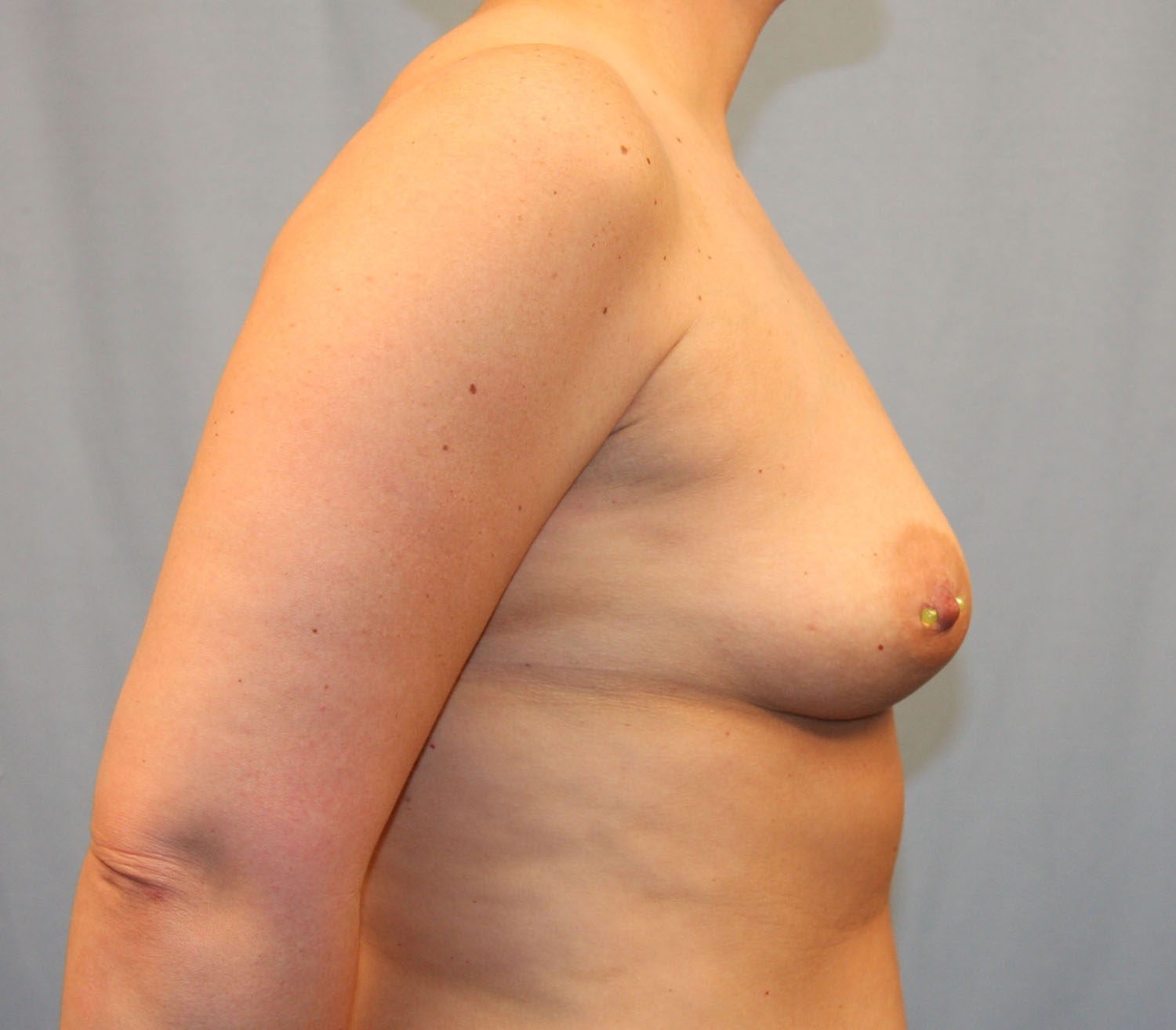 Before Image: Breast Augmentation with Mastopexy - right-side