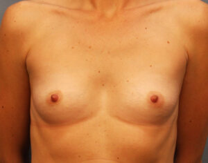 Before Image: Breast Augmentation with Mastopexy