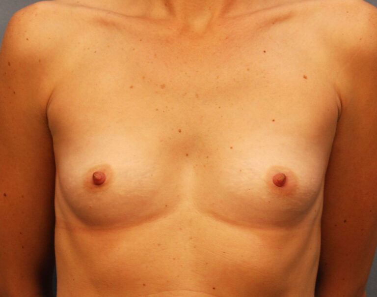 Before Image: Breast Augmentation with Mastopexy - front