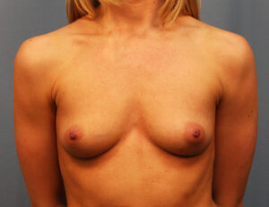 Before Image: Breast Augmentation with Mastopexy