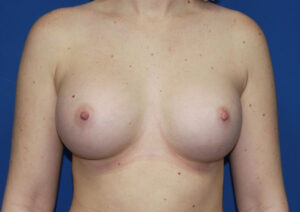 After Image: Breast Augmentation with Mastopexy