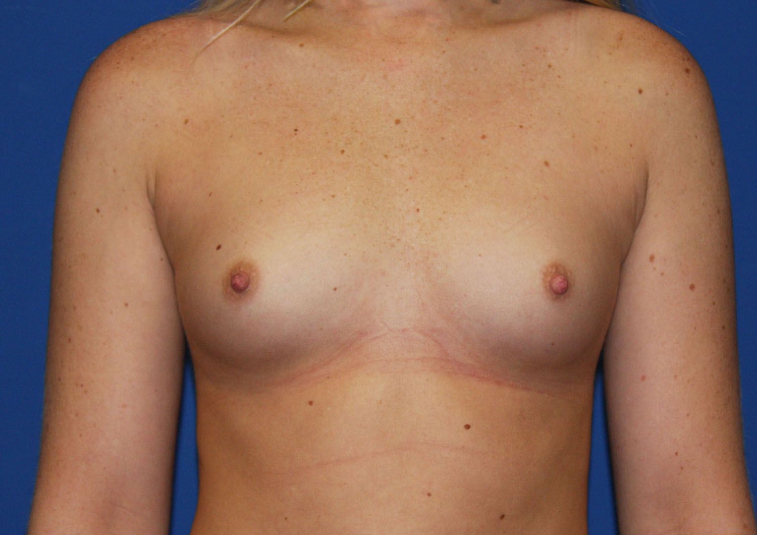Before Image: Breast Augmentation with Mastopexy - front
