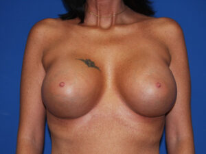 After Image: Breast Augmentation with Mastopexy