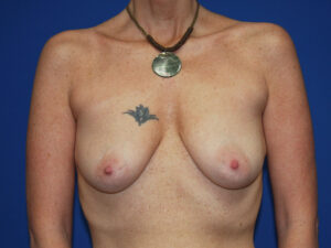 Before Image: Breast Augmentation with Mastopexy