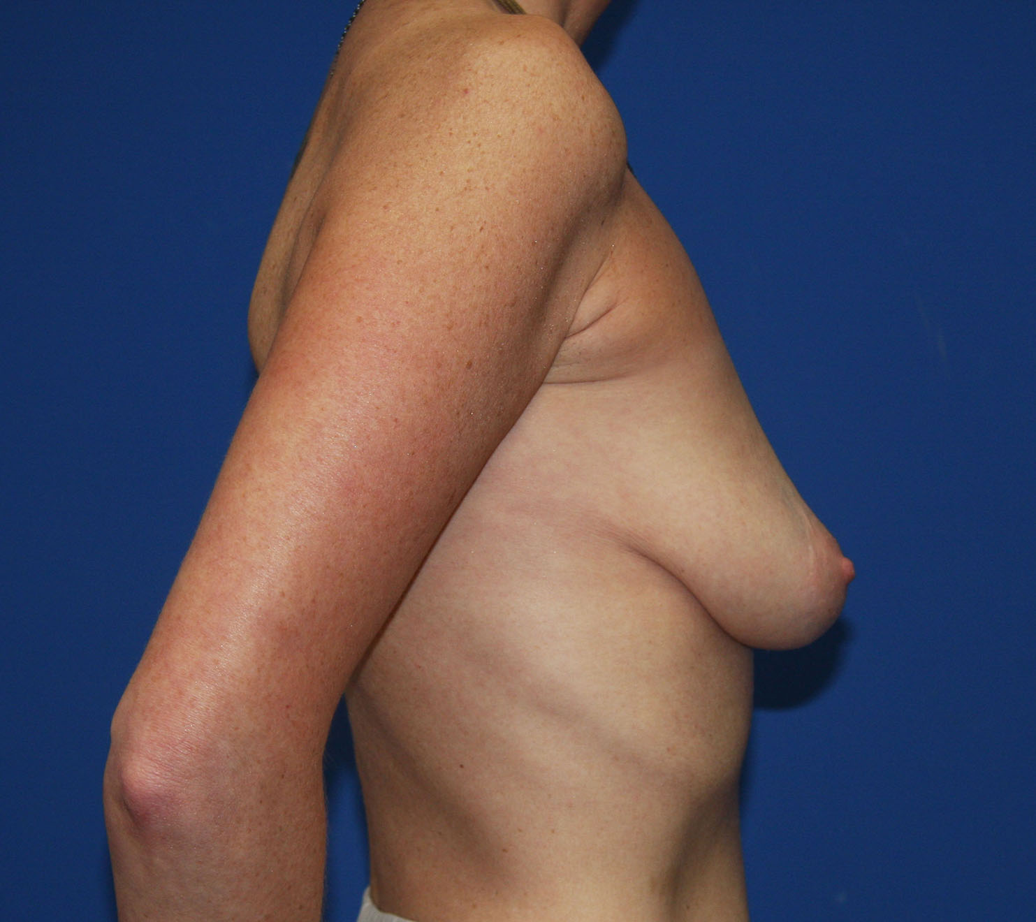 Before Image: Breast Augmentation with Mastopexy - right-side