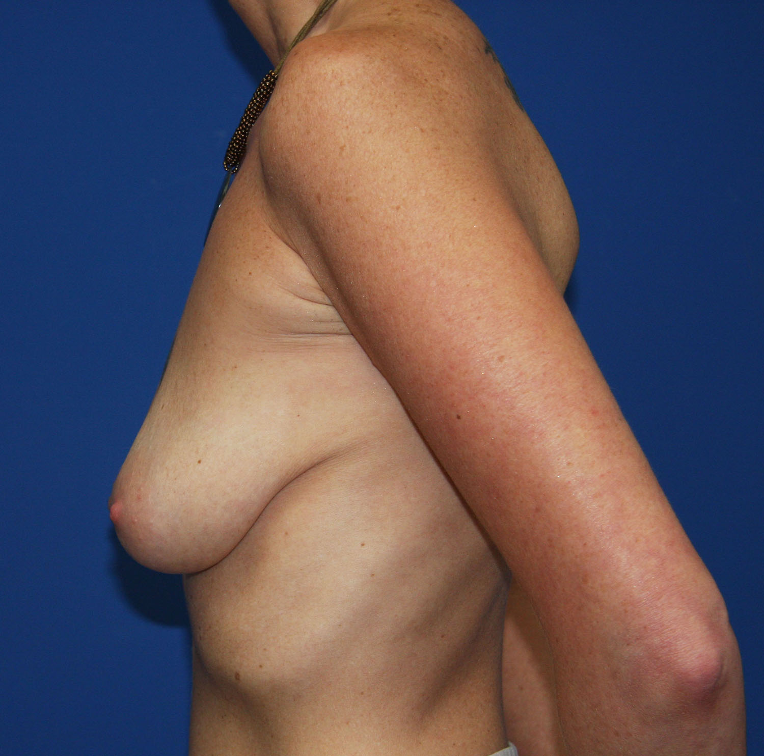 Before Image: Breast Augmentation with Mastopexy - left-side