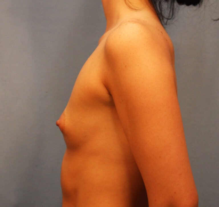Before Image: Breast Augmentation with Mastopexy - left-side