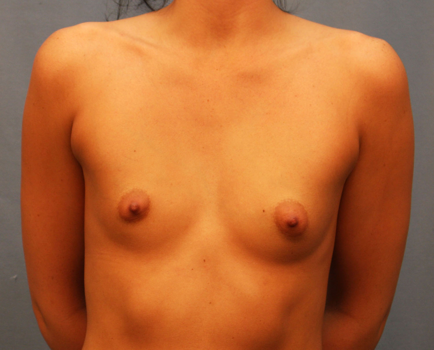 Before Image: Breast Augmentation with Mastopexy - front