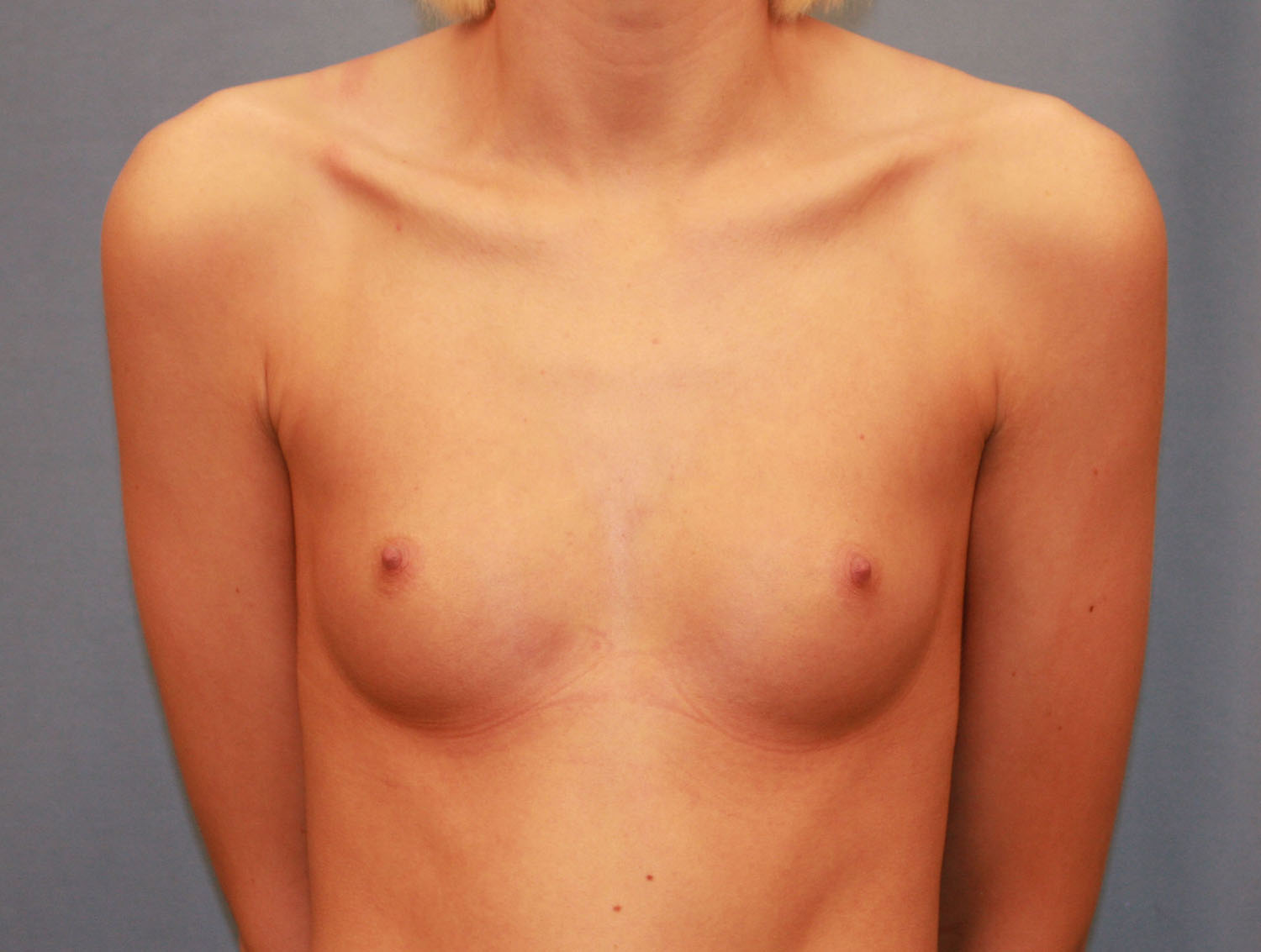 Before Image: Breast Augmentation with Mastopexy - front