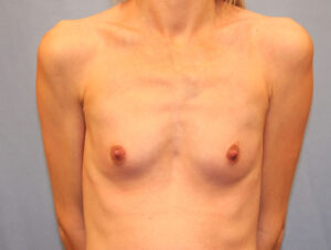 Before Image: Breast Augmentation with Mastopexy