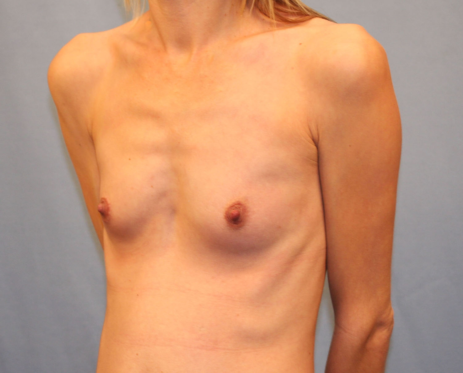 Before Image: Breast Augmentation with Mastopexy - left-front-oblique