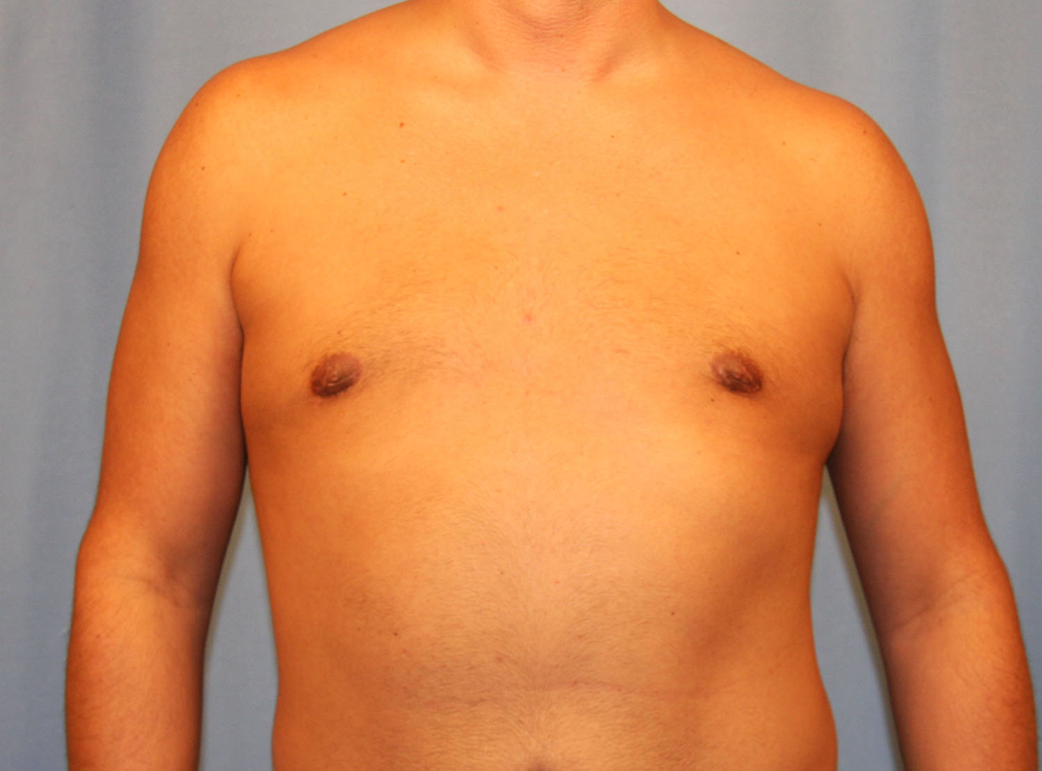 After Image: Gynecomastia - front