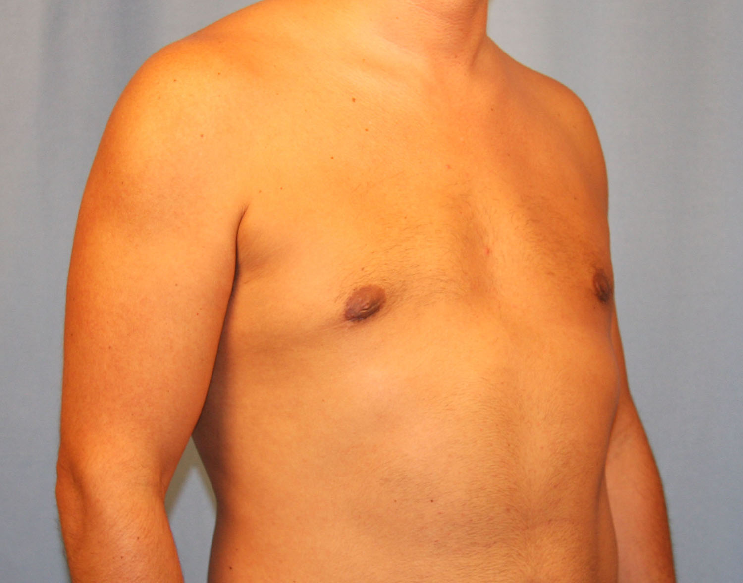 After Image: Gynecomastia - right-front-oblique