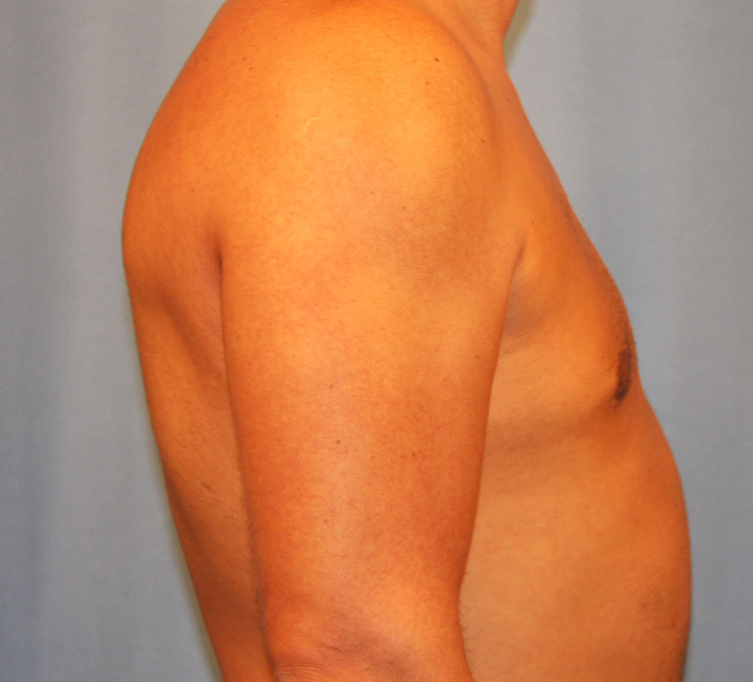 After Image: Gynecomastia - right-side