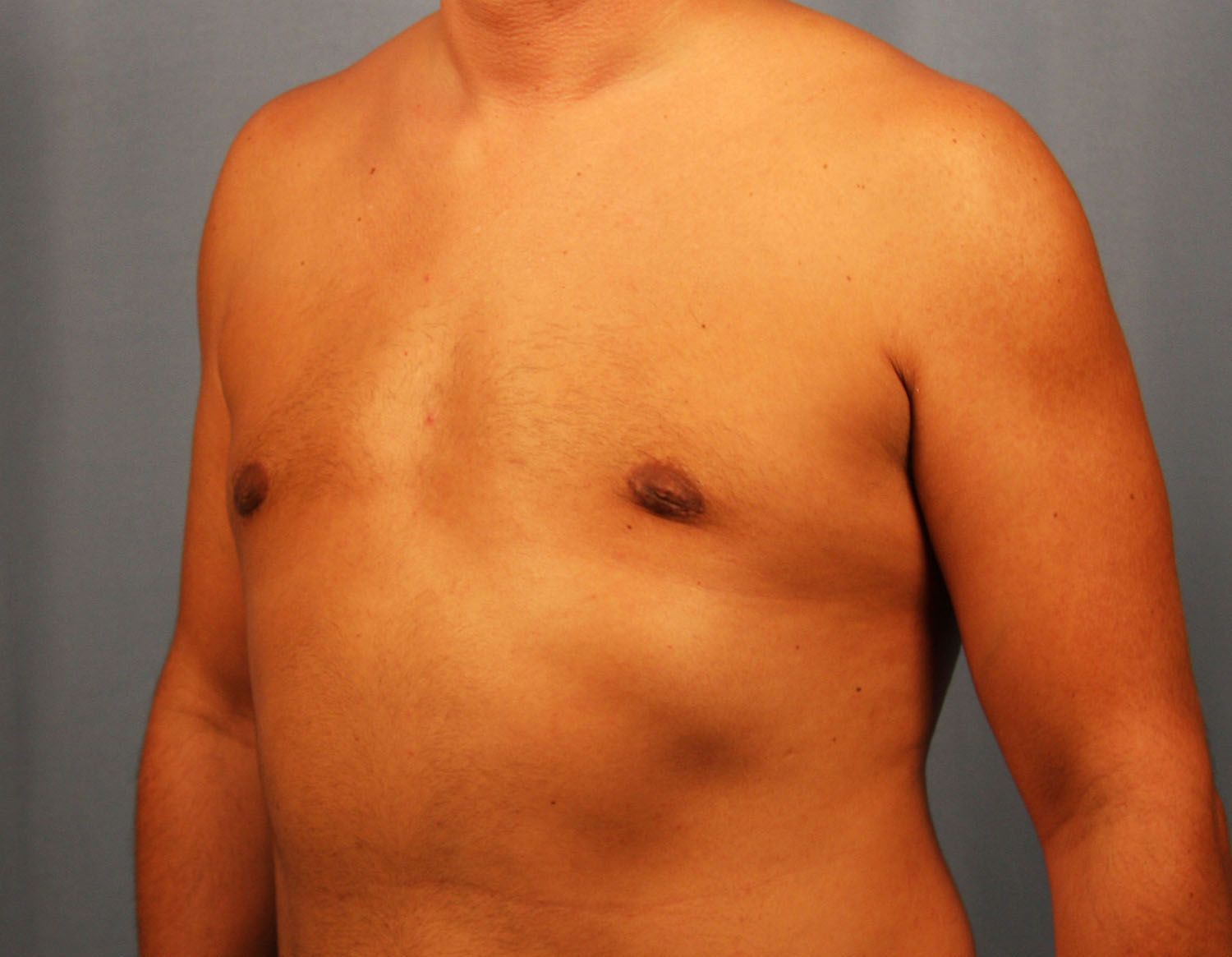 After Image: Gynecomastia - left-front-oblique