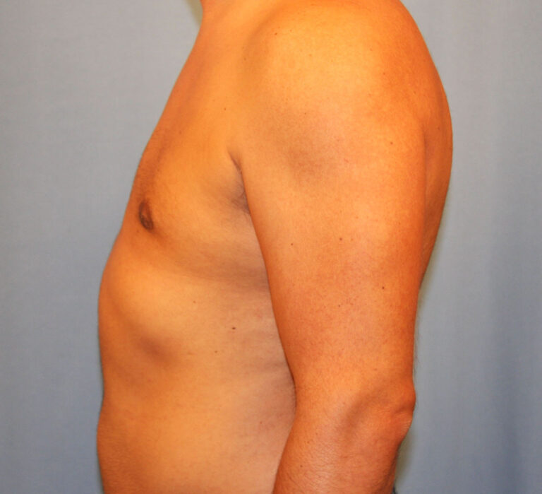 After Image: Gynecomastia - left-side