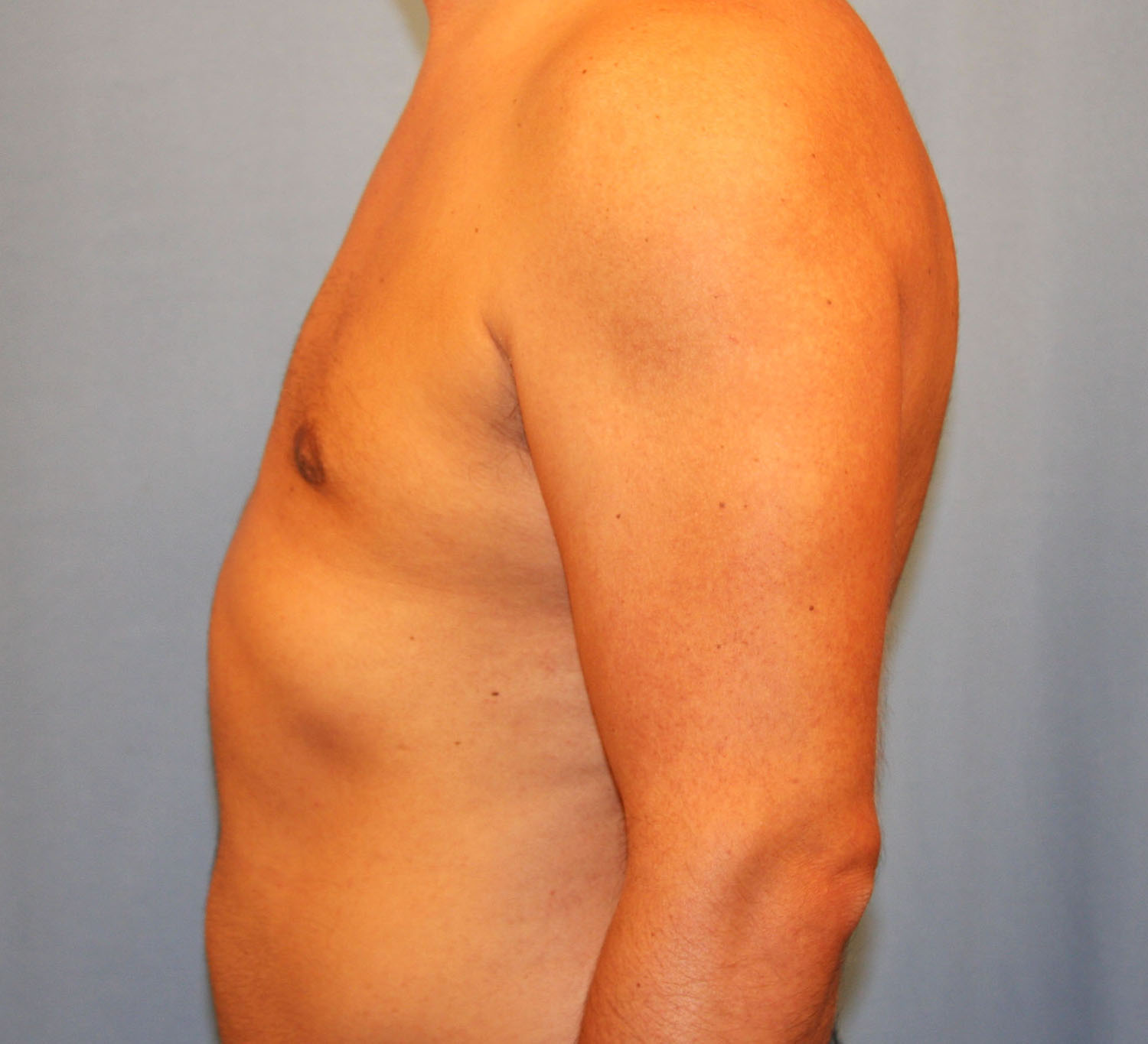 After Image: Gynecomastia - left-side