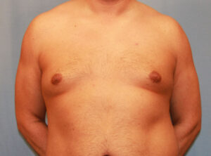 Before Image: Gynecomastia