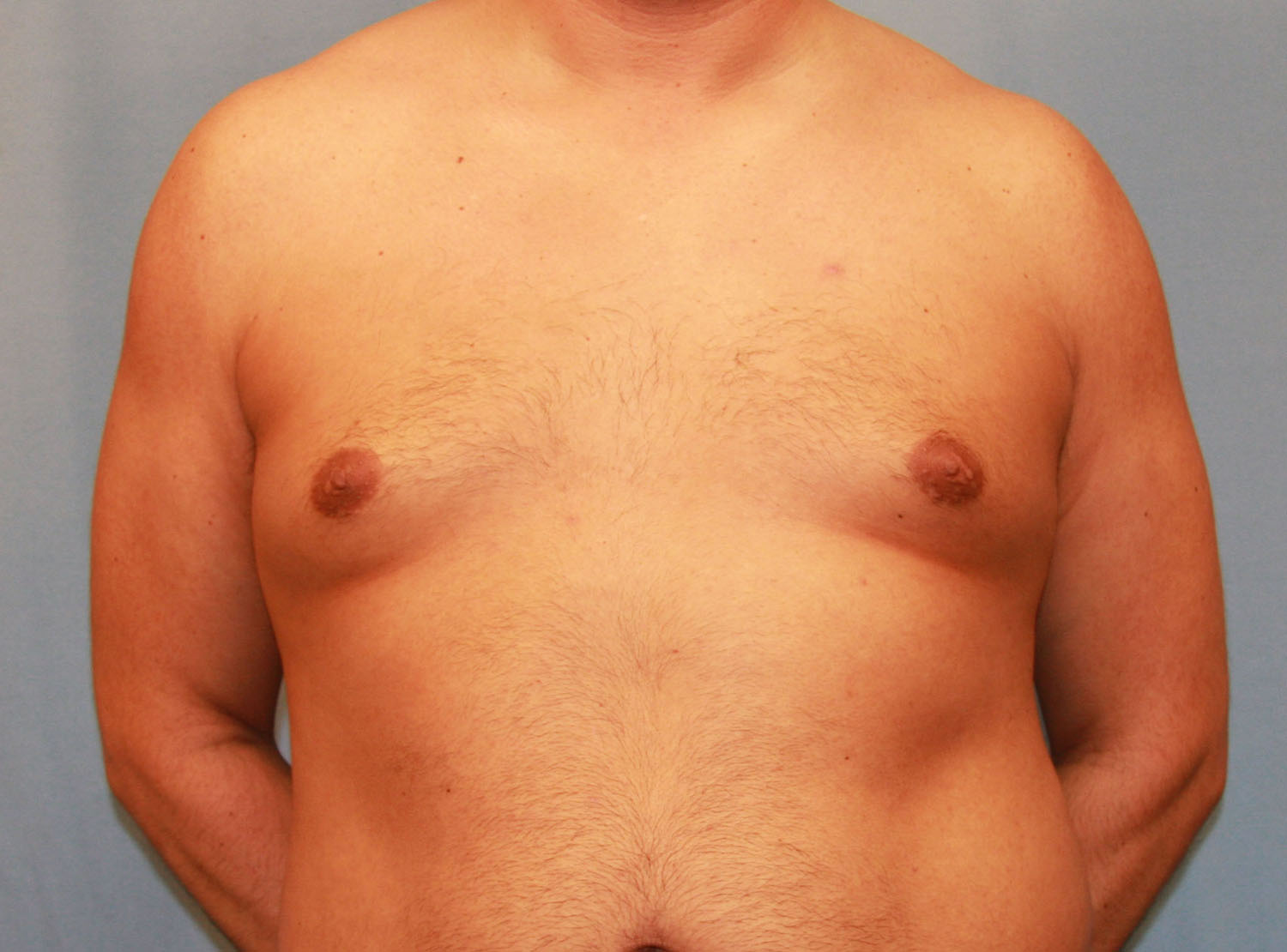 Before Image: Gynecomastia - front