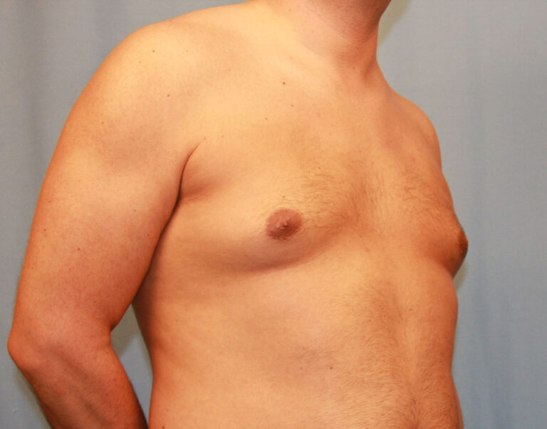 Before Image: Gynecomastia - right-front-oblique