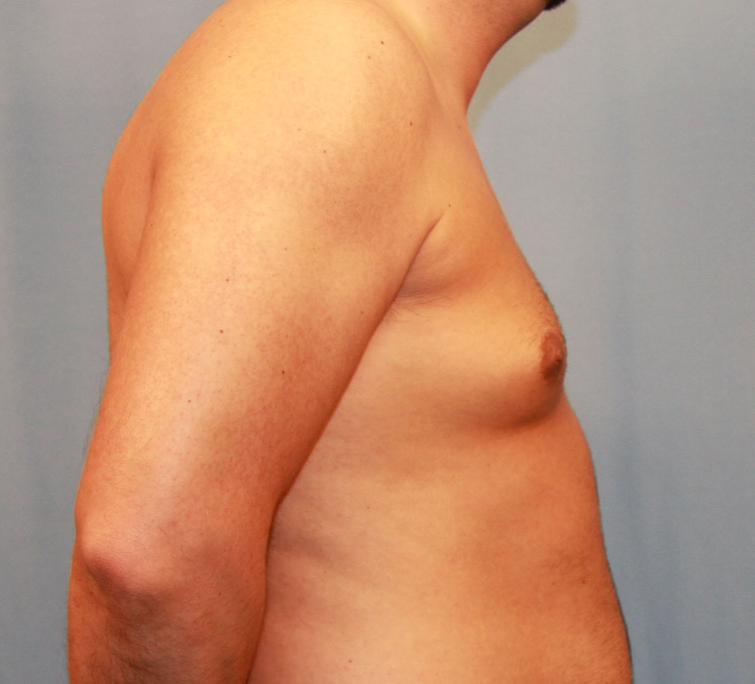 Before Image: Gynecomastia - right-side