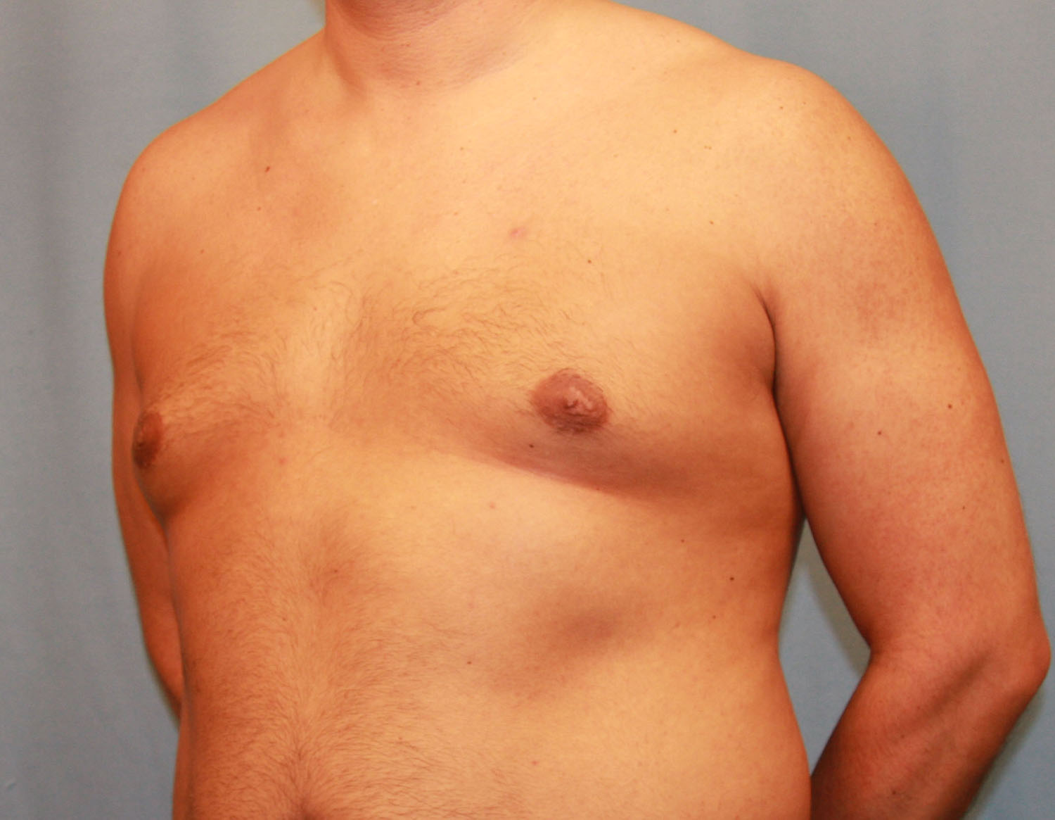 Before Image: Gynecomastia - left-front-oblique