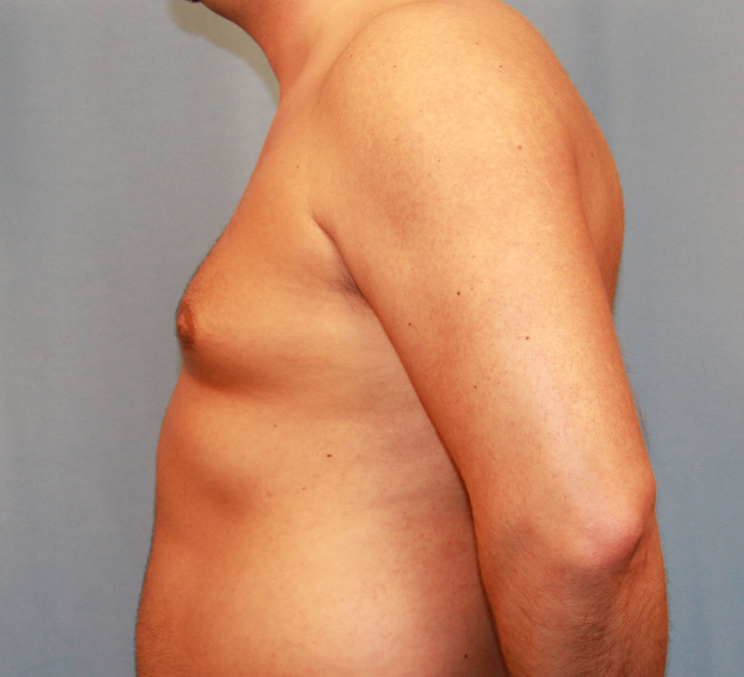 Before Image: Gynecomastia - left-side